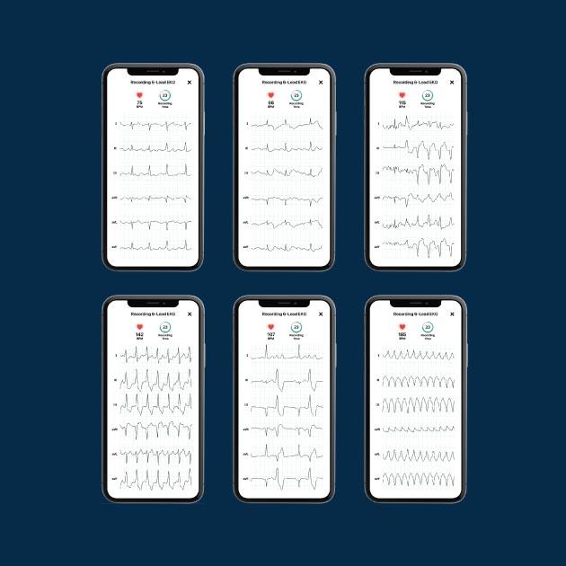 Przykładowy zapis EKG z urządzenia KardiaMobile 6L